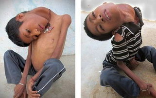 印度男孩患罕见疾病,脖子弯曲头部倒垂 