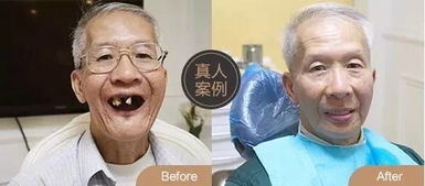 不出羊城看北大口腔名医 免挂号费,种牙每颗立减5000元 