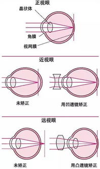 多大年龄需要散瞳(多少岁不需要散瞳验光)