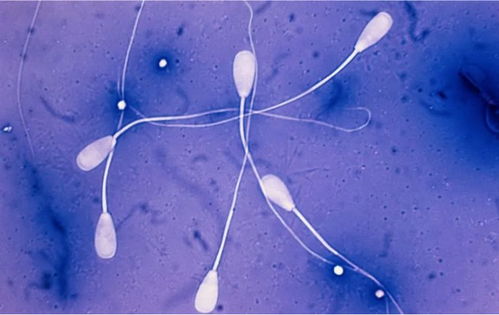 精子DNA碎片检测的临床意义