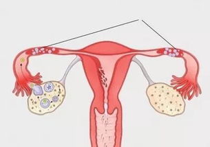 输卵管出现这种问题,很容易发生流产 胎停
