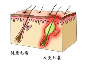 头发毛囊图片 毛囊是什么样子的