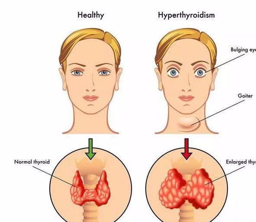 甲状腺结节癌变时,这3个症状不会骗人,你可要记清楚了