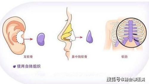 垫鼻子改变会很大吗 有哪些材料可以选择