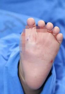 男婴长31个手指脚趾 脚趾矫正手术已成功完成 