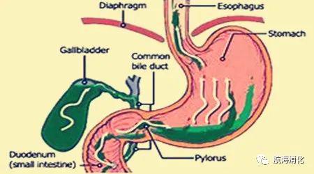 查出胆汁反流,这十大自我保健要点必须要记住