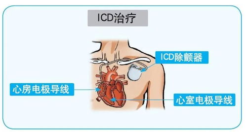 心脏骤停导致猝死 除了AED,还有ICD