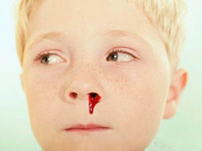 小孩流鼻血怎么办，小孩子流鼻血怎么办