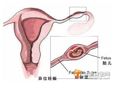 生殖道感染的生殖道感染有哪些危害