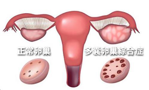 多囊卵巢综合征诊断？彩超怎么判断多囊卵巢综合症