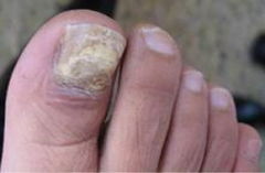 灰指甲什么症状 灰指甲有什么症状