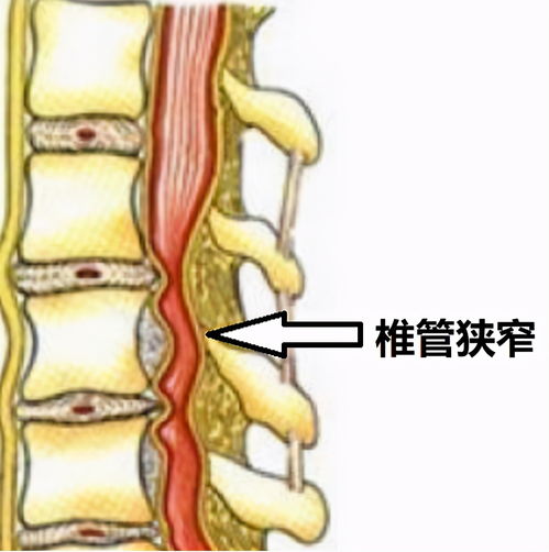 名医访谈丨上海同仁医院余将明 颈椎管狭窄常见问题