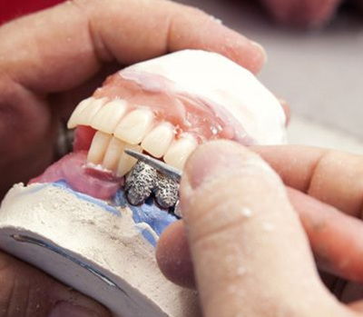 活动假牙日常怎么护理,什么时候更换 