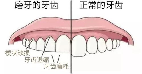 磨牙 碳酸饮料,20岁女孩把门牙磨平了