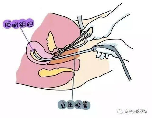 钳刮术简介