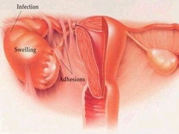 盆腔炎的危害有哪些 盆腔炎的危害是什么 盆腔炎危害有哪些 女性盆腔炎的危害 