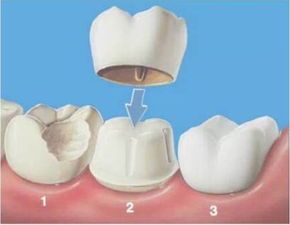 根管治疗后,为什么医生建议做烤瓷牙冠呢 