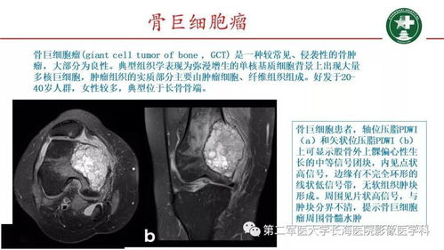 膝盖mri图像中的核磁共振片子是什么？