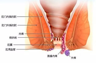 快医独家丨难以启齿的隐痛 痔疮