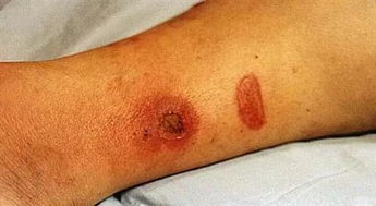 蜂窝织炎是什么病