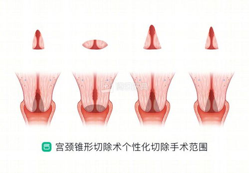 宫颈为何这么爱生病 女生最该了解的6个知识