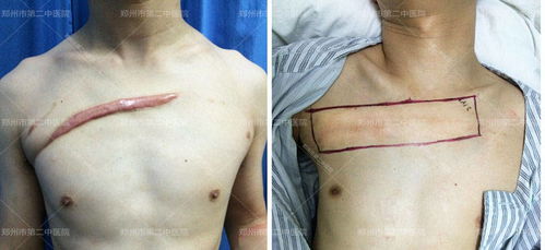 郑州市第二中医院 增生疤痕和疤痕疙瘩有什么区别
