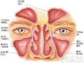 慢性筛窦炎，慢性筛窦炎早期症状有哪些