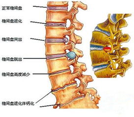 得了腰间盘突出,能跑步吗