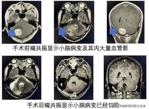 脑肿瘤手术出血多吗