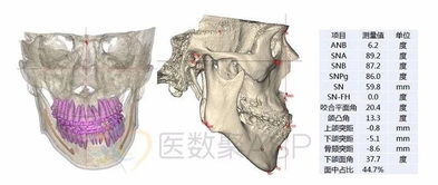 数字化手术辅助设计在偏颌畸形治疗中的应用 