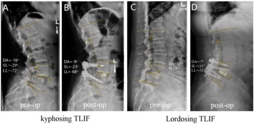 TLIF手术究竟是导致腰椎前突还是后突 一项临床影像学研究