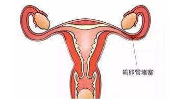 输卵管堵塞一定要试管才能怀上么 医生 有这些情况才需要试管