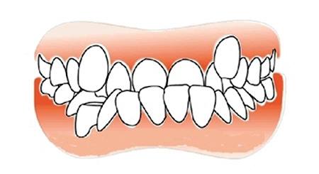 牙齿咬合关系不好,有什么影响