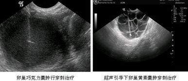 介入性超声在肿瘤病变治疗中的应用