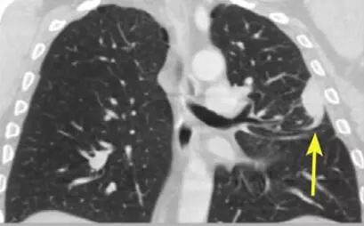 总结丨肺部疾病常见的CT征象