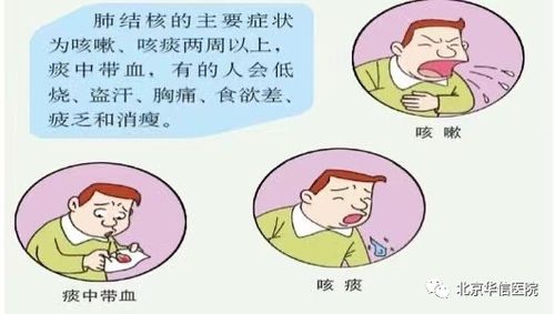 结核病防治,你了解多少