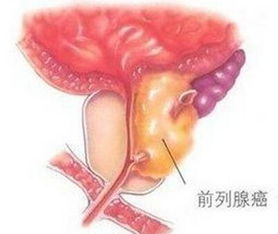 前列腺癌为什么不建议手术(前列腺癌不能手术怎么办能活多久)