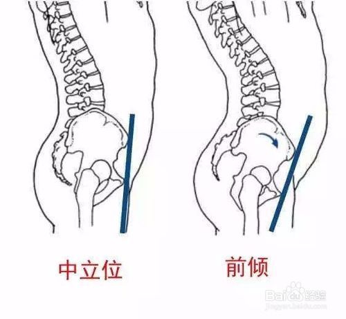 怎么样矫正骨盆前倾 