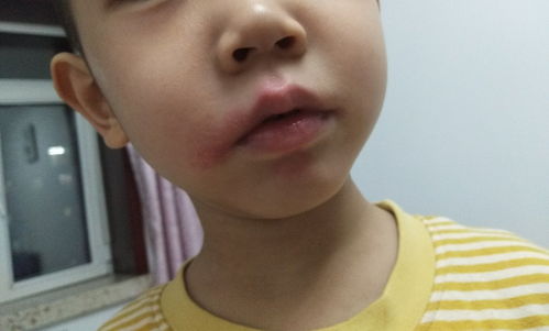 孩子嘴巴附近皮肤红,大概2个月左右了,又疼又痒请问是过敏还是什么 