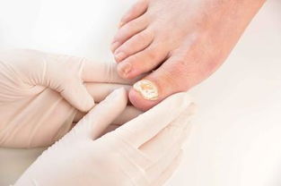 甲沟炎和灰指甲的主要区别是什么