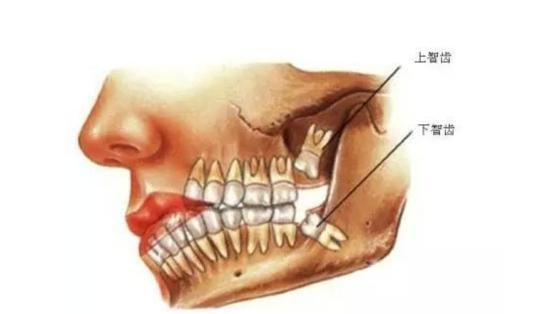 人类经过千万年的进化，为什么还保留生长智齿的能力(人类进化为什么还有智齿)
