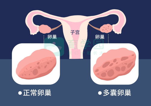 检查出多囊卵巢,就要看不孕不育了吗