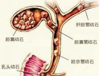 胆囊结石究竟该不该做手术 切除胆囊便万事大吉 一起了解下