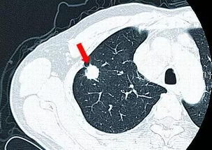 肺癌早筛 血液检测 肺结节自身抗体检测
