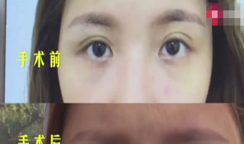 女子想做双眼皮,手术后变成 三眼皮 老公 老很多,难看很多