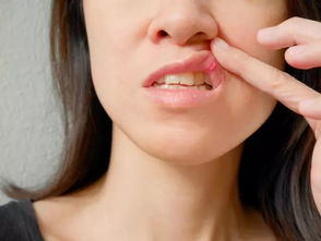 口腔溃疡伤口位置