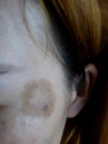 因为脸上这个疤真的让我很自卑,请问这个疤在哪可以去掉,跪求解答 