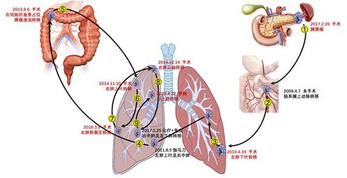 上海老太太胰腺癌复发6次,已活过10年,自述有三件 法宝 