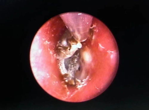 外耳道疖肿之后耳朵内起皮