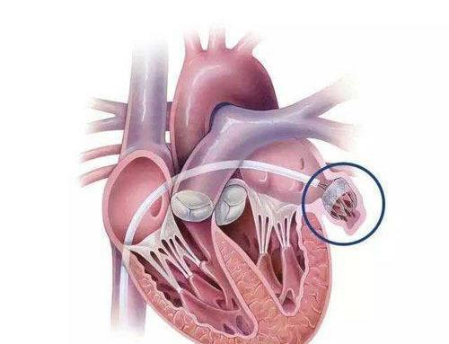 医生大白话这些心脏手术 心脏支架 搭桥 移植 起搏 射频